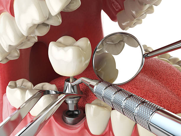 Best Emergency Root Canal Treatment in Memphis, MO